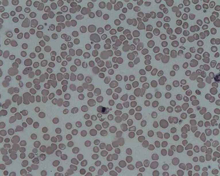 Inclusion Bodies of Red Blood Cells – The Art Of Medicine